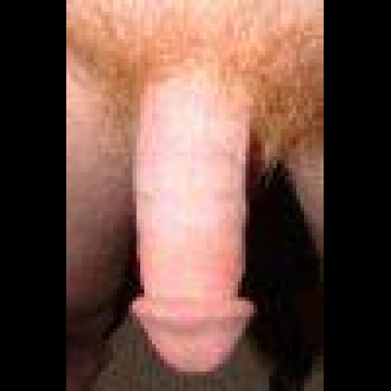 redunc